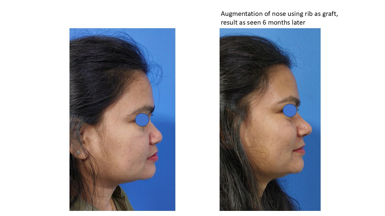 Rhinoplasty Photo 4